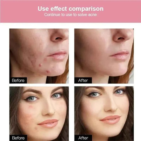 72/180pcs Hydrocolloid Acne Patch Waterproof Acne Removing PU Film Face Printing Spots Marks Invisible Acne Cleansing Patch